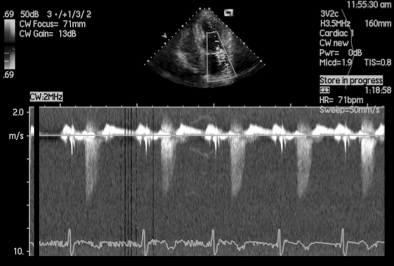 Mitral Regurgitation Quantification